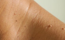 Dấu hiệu “nhỏ” trên da có thể cảnh báo tiểu đường, xuất hiện ở 4 vị trí này càng cần chú ý