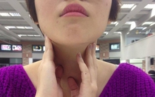 Cô gái 21 tuổi bất ngờ phát hiện ung thư nhờ dấu hiệu ít người chú ý trên cổ