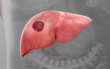 Người phụ nữ 52 tuổi phát hiện ung thư gan sau khi có những dấu hiệu lạ ở bụng