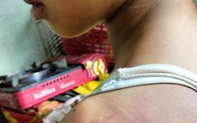 Nữ sinh lớp 4 bị 10 bạn cùng lớp đánh hội đồng bầm tím khắp người