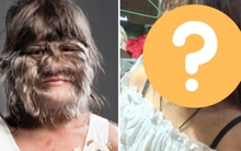 "Cô bé người sói" mắc chứng bệnh lạ cả thế giới chỉ có 50 người từng bị giờ ra sao ở tuổi trưởng thành?