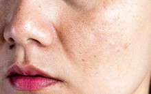 Thấy 2 loại bất thường này xuất hiện trên mặt bạn cần đi khám ung thư gan càng sớm càng tốt