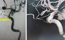 Cảnh giác với cơn đau đầu thường gặp ở người trẻ: Nguy cơ vỡ phình động mạch não