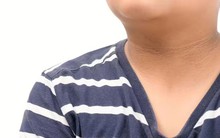 Tiểu đường có thể 'phát' dấu hiệu lạ ở cổ: Nếu thấy thì đừng chủ quan