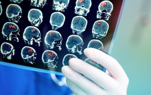 Chuyên gia gọi tên 6 “thủ phạm” làm tăng nguy cơ đột quỵ ở người trẻ: Không có tất cả thì xin chúc mừng!