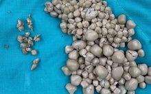 Cô gái ngoài 20 tuổi đã có tới 300 viên sỏi thận vì 2 thói xấu rất nhiều người trẻ mắc