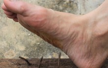 Giẫm phải chiếc đinh nhỏ, người đàn ông phải thở máy gần 1 tháng: Bác sĩ cảnh báo