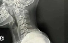 Bé gái 9 tuổi cột sống cổ "gập về phía trước", già như bà cụ 50 vì thứ mà trẻ nhỏ lẫn người lớn đều mê