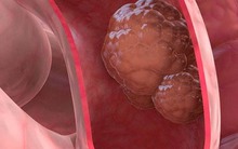 6 'thủ phạm' gây ra ung thư đại trực tràng, số 5-6 đang gia tăng ở người trẻ