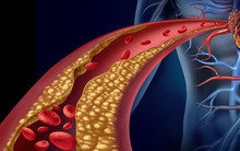 Bàn chân xuất hiện 4 dấu hiệu này, cẩn thận mỡ máu tăng cao bất thường