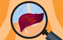 40 tuổi đã mắc ung thư gan: Rất bất ngờ vì không có triệu chứng gì ngoài đau bụng