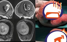 Mang thai đôi nhưng chỉ sinh một bé, 1 năm sau bố mẹ đưa con gái đi khám mới phát hiện sự thật đáng sợ nằm trong não