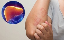 Bị viêm gan B nhưng không đi khám thường xuyên, lúc bệnh nặng mới phát hiện đã bị ung thư