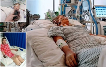 Người phụ nữ phải bỏ 2 chân và ngón tay vì căn bệnh triệu chứng giống cúm nhưng nguy hiểm gấp nhiều lần