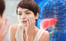 Có dấu hiệu này ở miệng, cẩn thận gan nhiễm mỡ 'ghé thăm'