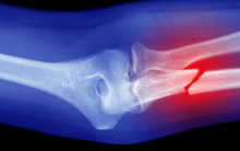 Lý do kỳ lạ và đáng lo ngại khiến xương của chúng ta ngày càng giòn, kể cả ở người trẻ