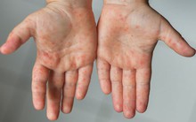 Gia đình có con dưới 5 tuổi chú ý: bệnh tay chân miệng đang vào mùa và đây là những điều cần biết để phòng tránh