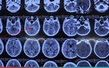 Cứu chồng bị nhồi máu não, vợ dùng vật nhọn chích đầu ngón tay, chân mà không ngờ hậu quả