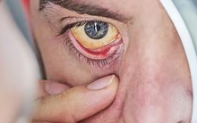 Bác sĩ lên truyền hình, cảnh báo 2 dấu hiệu ở mắt có thể ‘gióng lên hồi chuông cảnh báo’ bệnh tật