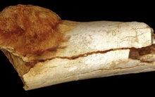 Ca ung thư cổ xưa nhất từng được ghi nhận ở loài người diễn ra từ lúc nào?