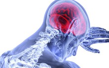 5 triệu người chết vì đột quỵ năm 2030: Cảnh báo 7 nguyên nhân hàng đầu