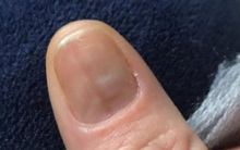 Phát hiện mắc ung thư sau khi có dấu hiệu kỳ lạ trên móng tay