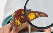 36 tuổi mắc ung thư gan, 'thủ phạm' là thứ quen mặt, nhiều người Việt mang trong người nhưng thờ ơ