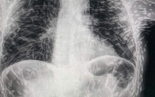 Người đàn ông ho 2 tháng không khỏi, chụp X-quang thì kinh ngạc phát hiện khắp người nổi đốm trắng: toàn là trứng ký sinh trùng