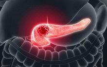 2 triệu chứng sớm cảnh báo ung thư tụy xuất hiện trước đó tới 1 năm