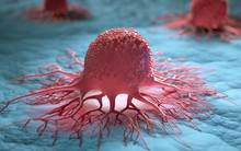 Cơ thể xuất hiện ''3 đen'', cẩn thận ung thư đang ''rình rập''