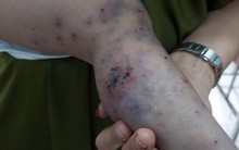 TP HCM: Một ca tử vong vì bệnh tay chân miệng