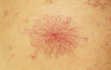 Da xuất hiện những điểm này có thể là dấu hiệu gan đang 'kêu cứu'