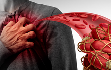 Chế độ ăn ít "2 trắng" và nhiều "3 vàng" giảm nguy cơ huyết khối