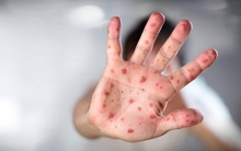 5 dấu hiệu tay chân miệng chuyển nặng