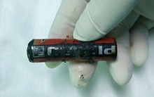 Cọ xát pin vào nhau, bé trai bị pin nổ phải nhập viện