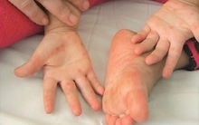 Ghi nhận gần 9.000 ca tay chân miệng, 3 người tử vong: Bộ Y tế chỉ đạo khẩn