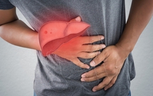 Một triệu chứng của ung thư gan rất dễ nhầm với chứng khó tiêu, cần biết rõ để hành động kịp thời