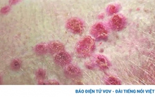 Trung Quốc bùng phát dịch đậu mùa khỉ với hơn 100 ca bệnh