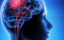 Người đàn ông 41 tuổi phát hiện khối u trong não nhờ một dấu hiệu lạ khi uống nước