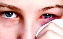 Bác sĩ cảnh báo về 1 căn bệnh dễ lây mạnh trong mùa hè và hướng dẫn cách xử trí