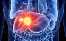 2 yếu tố khiến tỷ lệ tử vong do ung thư gan tăng vọt tại Anh: Nhiều người Việt cũng có 2 điểm này