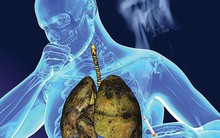 Một loại ung thư đang có dấu hiệu trẻ hóa – Nguyên nhân đến từ 3 thói quen tai hại mà nhiều người thường làm