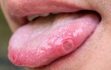 4 'thủ phạm' gây ra ung thư lưỡi, nhiều người Việt vẫn đang duy trì