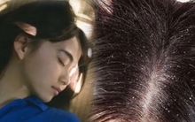 1 dấu hiệu ung thư da đầu rất giống với gàu, chủ quan bỏ qua dễ khiến bệnh nặng khó chữa