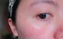 6 dấu hiệu trên khuôn mặt tiết lộ sức khỏe của bạn