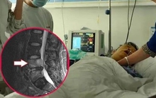 Đau lưng nên khám xương khớp, ai ngờ bị ung thư phổi “ăn mòn” 2 đốt sống