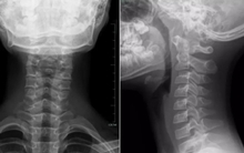 10 tuổi cột sống cổ đã cong vẹo, không cử động được vì thói quen của nhiều người