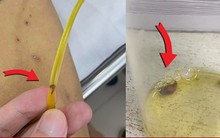 Thích ăn gỏi cá, sán lá gan chui ra từ ống dẫn lưu đường mật