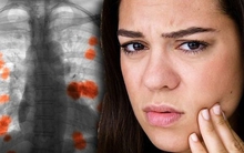 Dấu hiệu cảnh báo ung thư phổi xuất hiện ngay trên khuôn mặt, nếu chú ý có thể phát hiện bệnh giai đoạn sớm