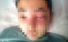 Bị viêm màng não vì việc tưởng vô hại nhiều người làm với khuôn mặt